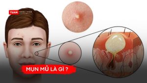 Mụn mủ là gì ?