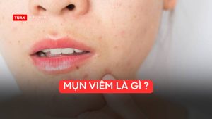Mụn viêm là gì ?