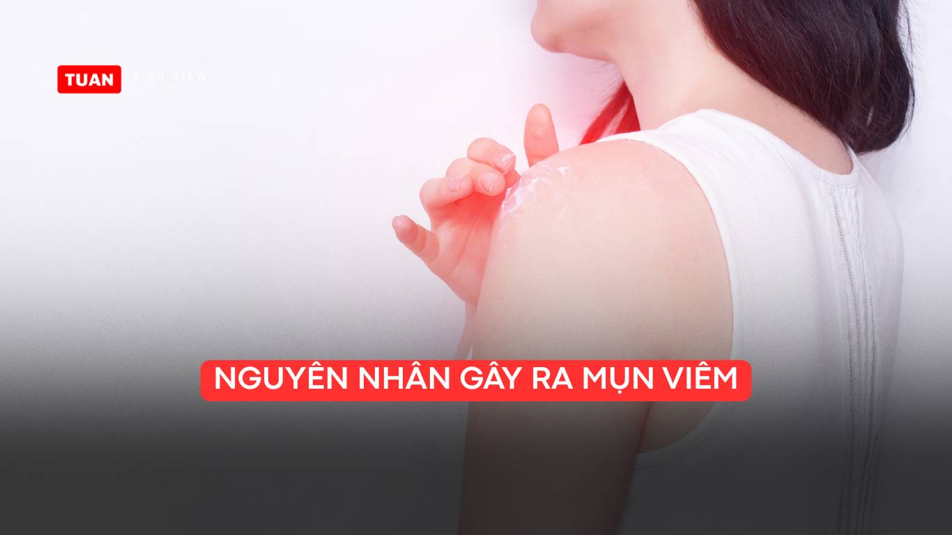 Nguyên nhân gây ra mụn viêm